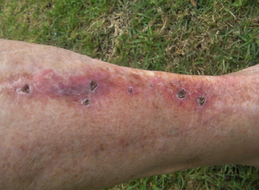 Scabs forming on skin