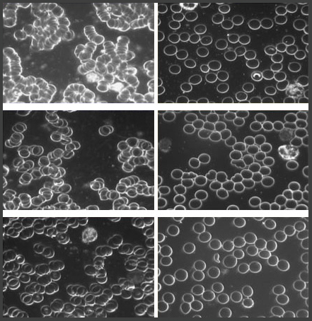 Blood Viscosity Earthing