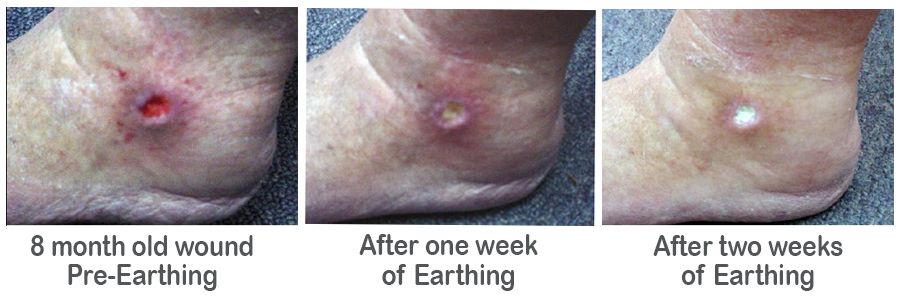 Wound Healing with Earthing