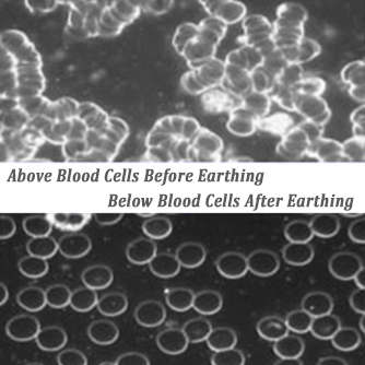 How Earthing May Help Reverse Anemia Disorders